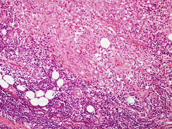 1N4 Lymphomatoid Granulomatosis (Case 1) H&E skin 2 (2)