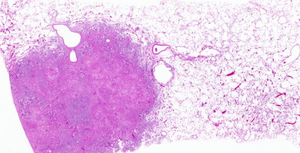 1O1 Lymphomatoid Granulomatosis (Case 1) H&E lung WM