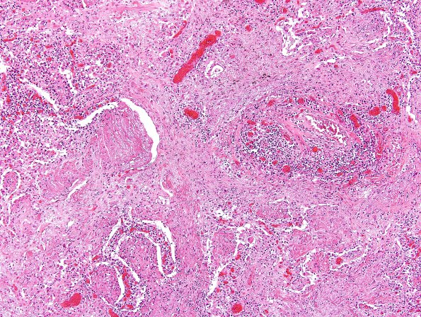 1O2 Lymphomatoid Granulomatosis (Case 1) H&E lung 4