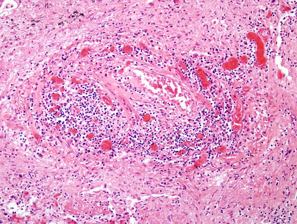 1O3 Lymphomatoid Granulomatosis (Case 1) H&E lung 2