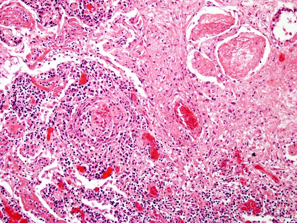 1O4 Lymphomatoid Granulomatosis (Case 1) H&E lung 1