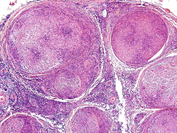 2A1 Lymphomatoid granulomatosis (Case 2) H&E 3