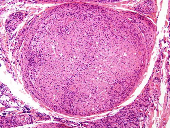 2A2 Lymphomatoid Granulomatosis (Case 2) H&E 7