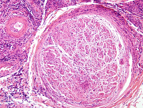 2A3 Lymphomatoid Granulomatosis (Case 2) H&E 8