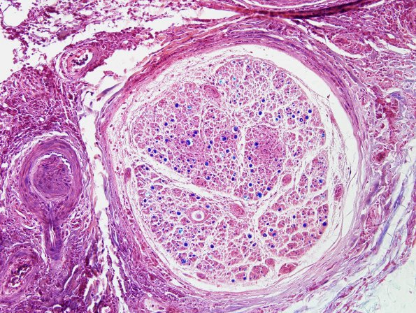 2A4 Lymphomatoid Granulomatosis (Case 2) LFB-H&E 4