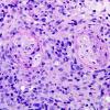 2A5 Lymphomatoid Granulomatosis (Case 2) PAS