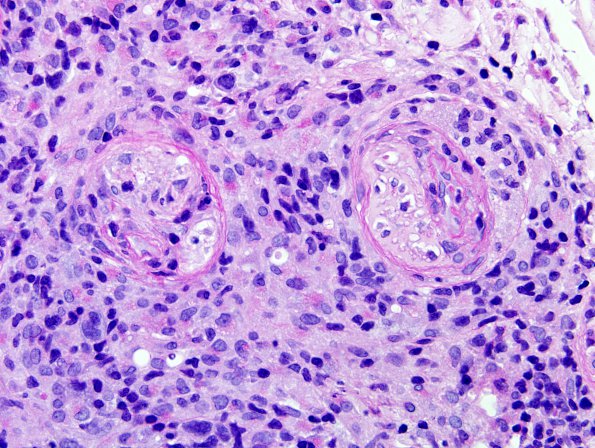 2A5 Lymphomatoid Granulomatosis (Case 2) PAS