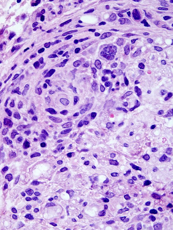 2A7 Lymphomatoid Granulomatosis (Case 2) H&E