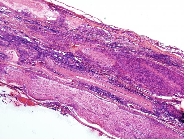 2B1 Lymphomatoid Granulomatosis (Case 2) H&E 1