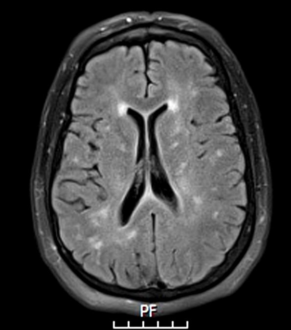 1A1 Lymphomatosis cerebri (Case 1) FLAIR - Copy