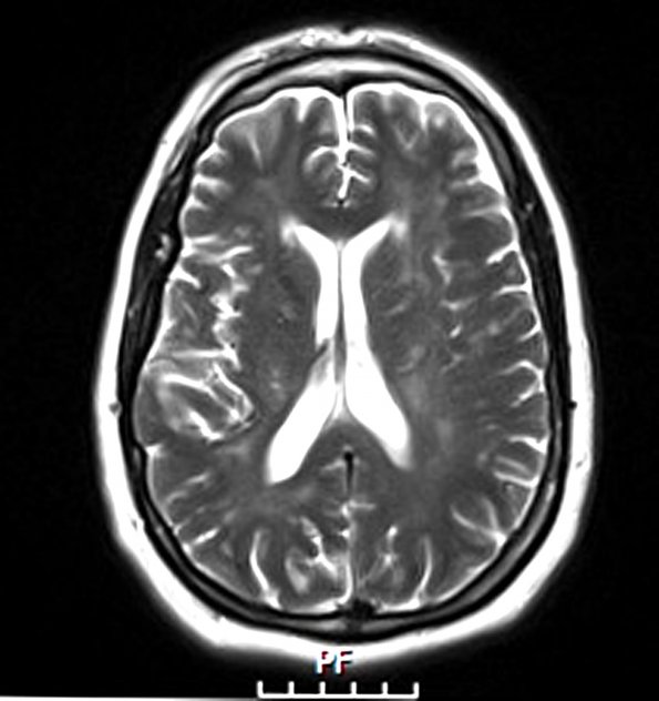 1A2 Lymphomatosis cerebri (Case 1) T2 - Copy