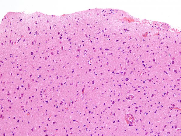 1B2 Lymphomatosis cerebri (Case 1) H&E 20X 1