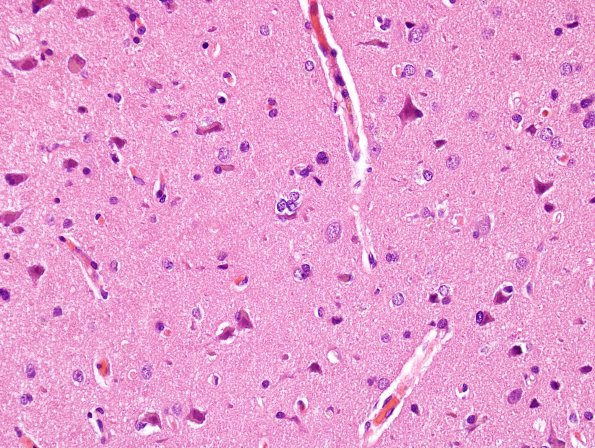 1B3 Lymphomatosis cerebri (Case 1) H&E 5
