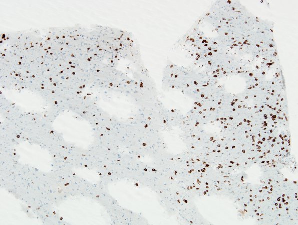 1C1 Lymphomatosis cerebri (Case 1) A1 10x CD 20