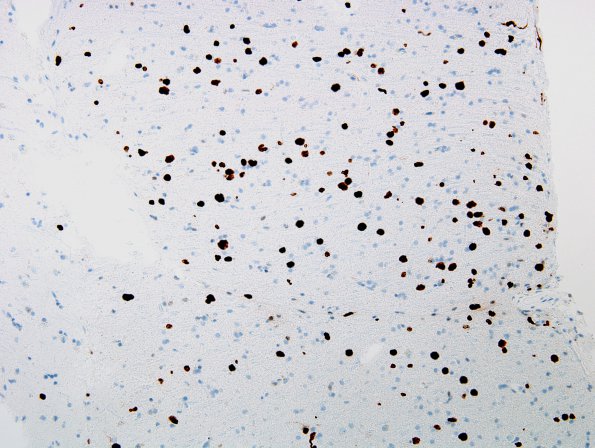 1D3 Lymphomatosis cerebri (Case 1) MIB 20X