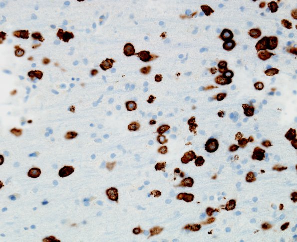 1E1 Lymphomatosis cerebri (Case 1) CD20 40X