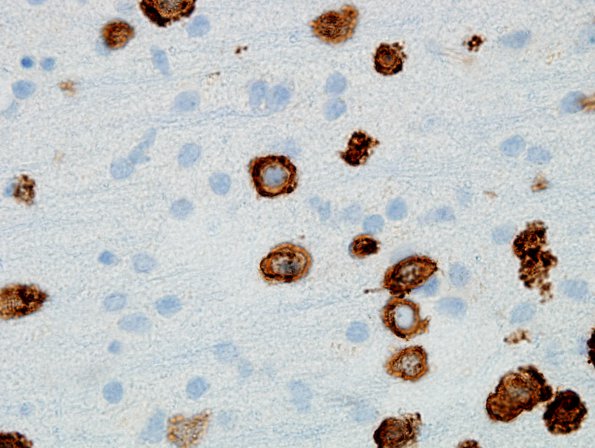 1F1 Lymphomatosis cerebri (Case 1) CD20 100X 1