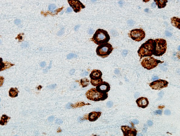 1F2 Lymphomatosis cerebri (Case 1) CD20 100X 2