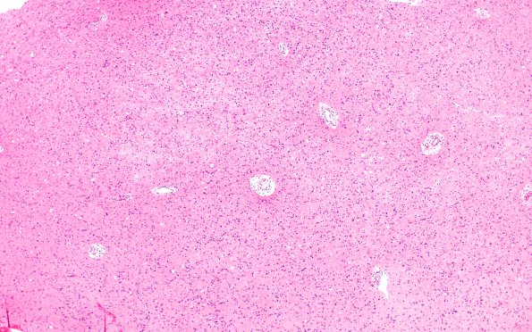 2A1 Lymphomatosis Cerebri (Case 2) H&E 4X