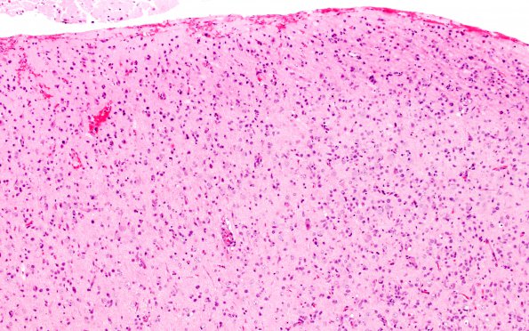 2A2 Lymphomatosis Cerebri (Case 2) H&E 10X