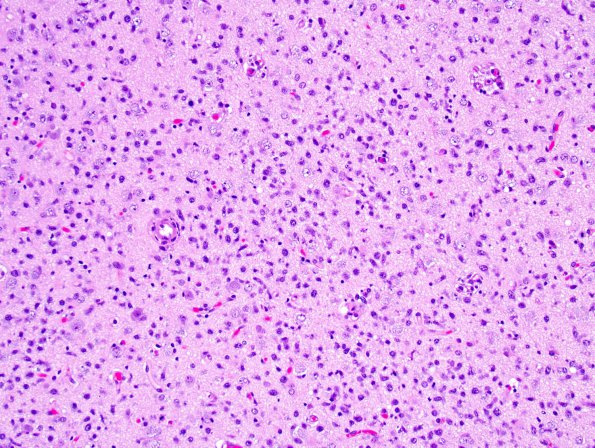 2A3 Lymphomatosis Cerebri (Case 2) 1.jpg