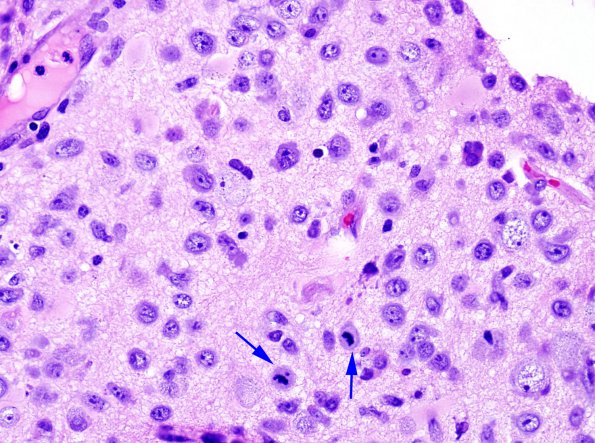 2A4 Lymphomatosis Cerebri (Case 2) 13 copy