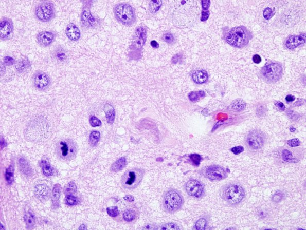 2A5 Lymphomatosis Cerebri (Case 2) 10