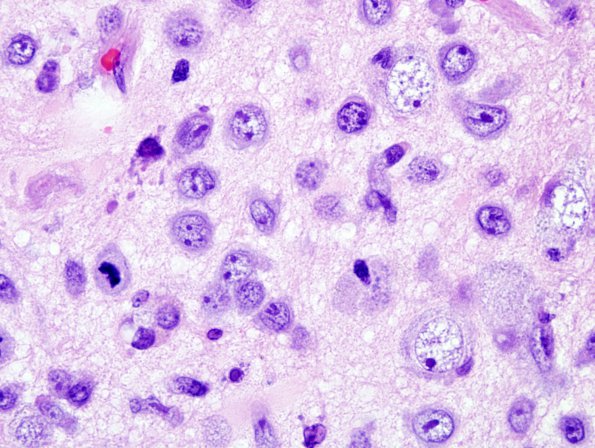 2A6 Lymphomatosis Cerebri (Case 2) 11