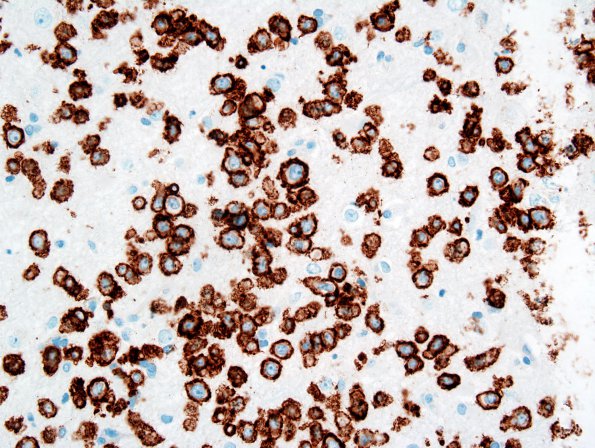 2B Lymphomatosis Cerebri (Case 2) CD20 1.jpg