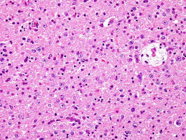 3A Lymphoma, Infiltrative (Case 3) H&E