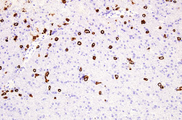 3B1 Lymphoma, Infiltrative (Case 3) CD20