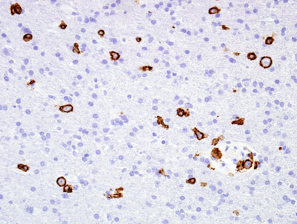 3B2 Lymphoma, Infiltrative (Case 3) CD20