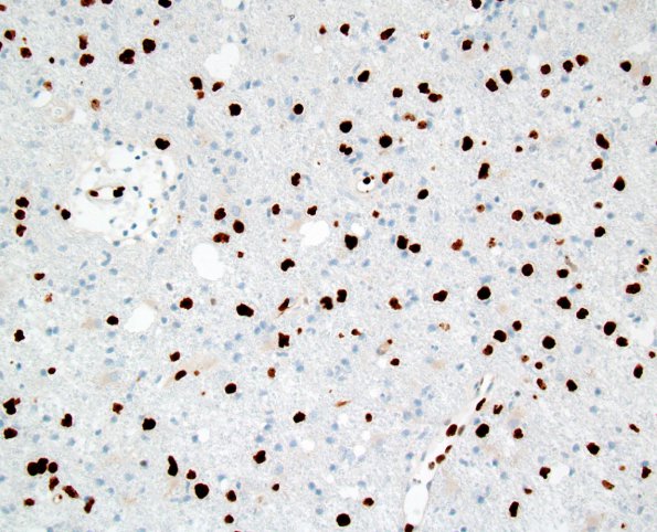 3C1 Lymphomatosis Cerebri (Case 3) Ki-67 1.jpg