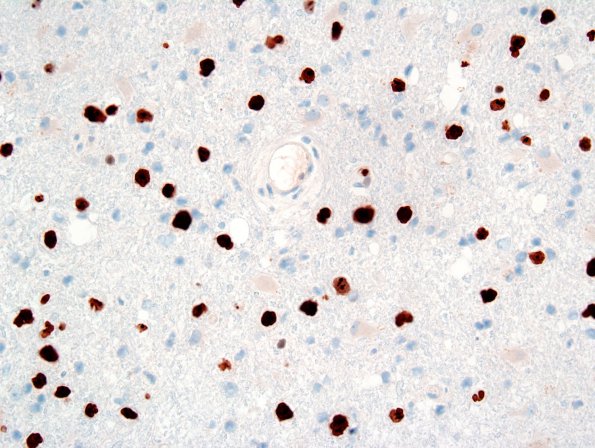 3C2 Lymphomatosis Cerebri (Case 3) Ki-67 3.jpg