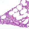 10A Plasma Cell Dyscrasia (Case 10) H&E