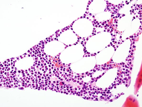 10A Plasma Cell Dyscrasia (Case 10) H&E