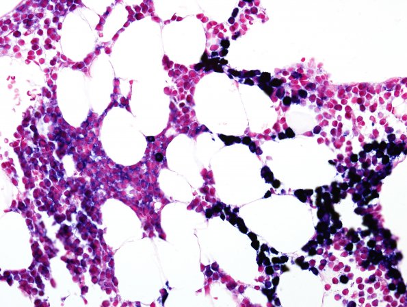 10C Plasma Cell Dyscrasia (Case 10) Kappa ISH