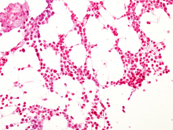 10D Plasma Cell Dyscrasia (Case 10) Lambda ISH