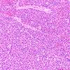 11B1 Plasma Cell Neoplasm (Case 11) H&E 20X 1