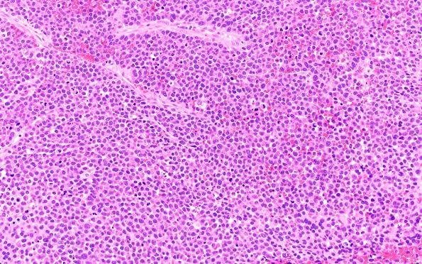 11B1 Plasma Cell Neoplasm (Case 11) H&E 20X 1