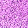 11B2 Plasma Cell Neoplasm (Case 11) H&E 40X 1