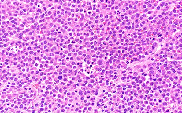 11B2 Plasma Cell Neoplasm (Case 11) H&E 40X 1