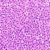 11B3 Plasma Cell Neoplasm (Case 11) H&E 40X 2