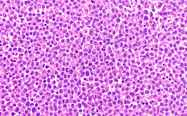 11B3 Plasma Cell Neoplasm (Case 11) H&E 40X 2