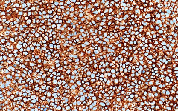 11C Plasma Cell Neoplasm (Case 11) CD138 40X