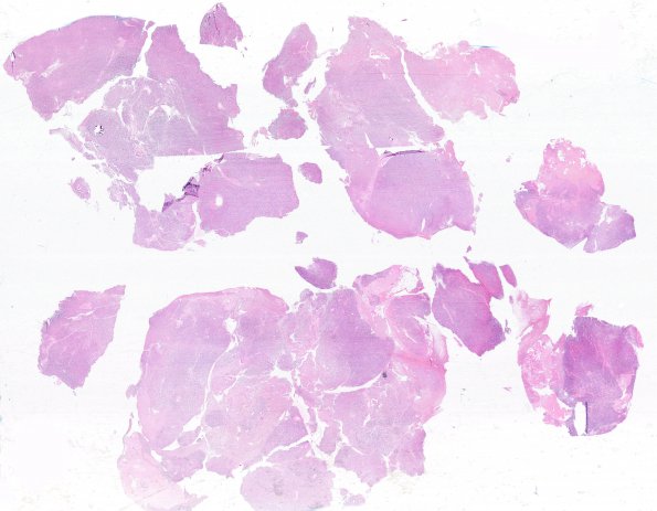 11E2 Plasmacytoma (Case 11) ISH Lambda WM A