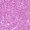 12B1 Plasma cell neoplasm (Case 12) H&E 4.jpg