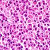 12B2 Plasma cell neoplasm (Case 12) H&E 1.jpg