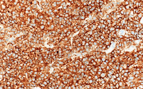 12C Plasmacytoma (Case 12) CD138 40X