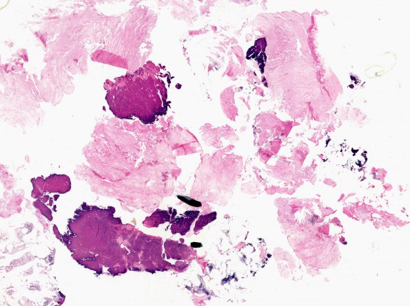 12E1 Plasma cell neoplasm (Case 12) Kappa ISH